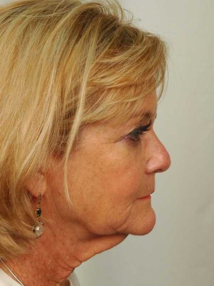 Neck Lift Before & After Patient #1130