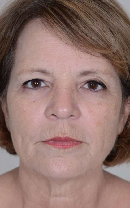 Neck Lift Before & After Patient #1145