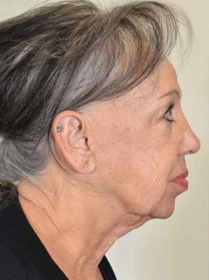 Neck Lift Before & After Patient #1150