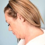 Neck Lift Before & After Patient #1157