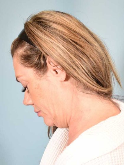 Neck Lift Before & After Patient #1157