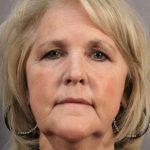 Brow Lift Before & After Patient #1187