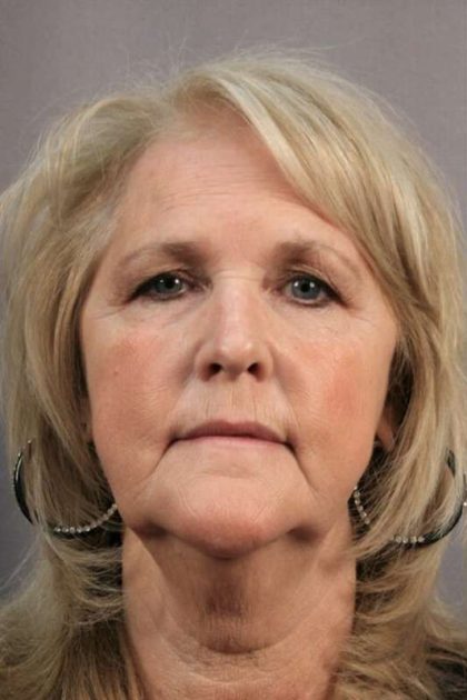 Brow Lift Before & After Patient #1187