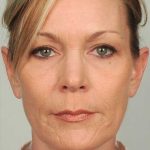 Brow Lift Before & After Patient #1196