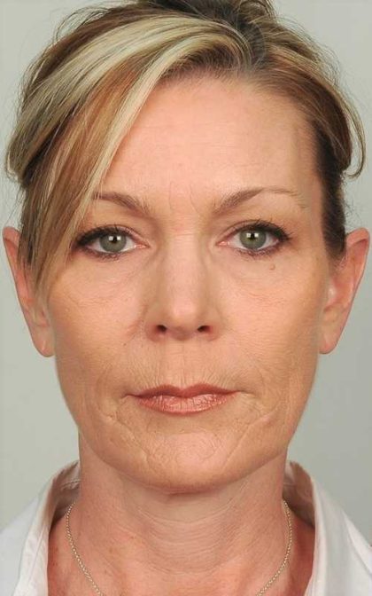 Brow Lift Before & After Patient #1196