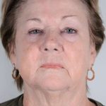 Facial Fat Transfer & Grafting Before & After Patient #1208