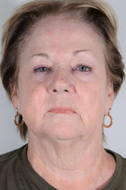 Facial Fat Transfer & Grafting Before & After Patient #1208