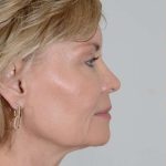 Facial Fat Transfer & Grafting Before & After Patient #1215