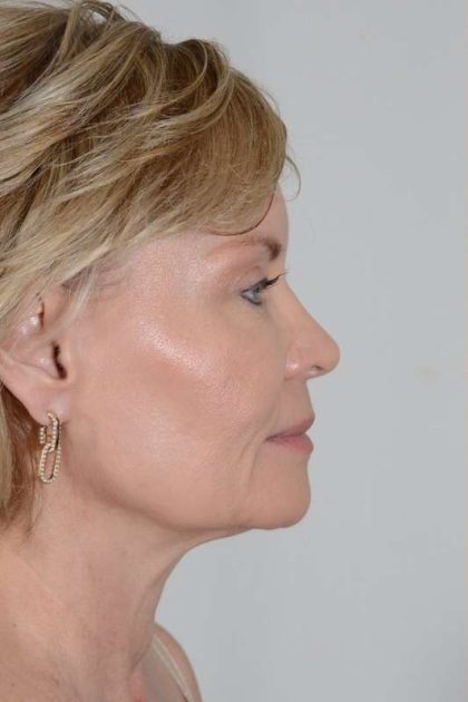 Facial Fat Transfer & Grafting Before & After Patient #1215