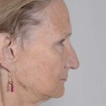 Facial Fat Transfer & Grafting Before & After Patient #1220