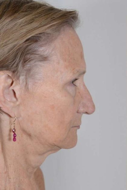 Facial Fat Transfer & Grafting Before & After Patient #1220