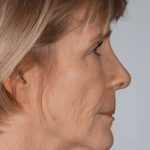 Facial Fat Transfer & Grafting Before & After Patient #1225