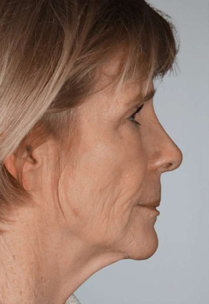 Facial Fat Transfer & Grafting Before & After Patient #1225