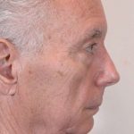Facial Fat Transfer & Grafting Before & After Patient #1230