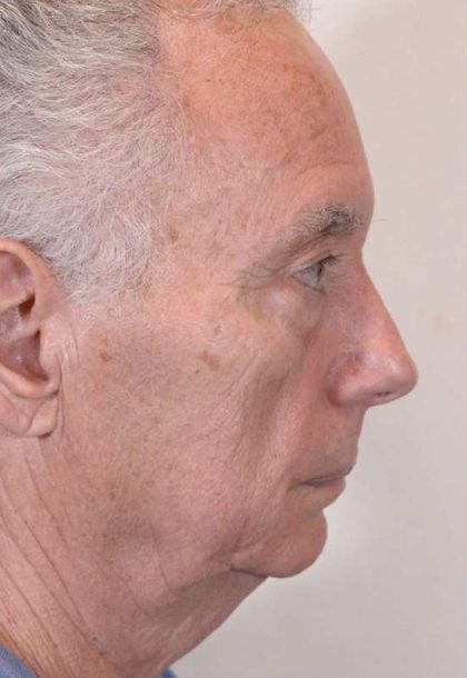 Facial Fat Transfer & Grafting Before & After Patient #1230