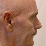 Facial Fat Transfer & Grafting Before & After Patient #1235