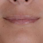 Facial Fat Transfer & Grafting Before & After Patient #1238