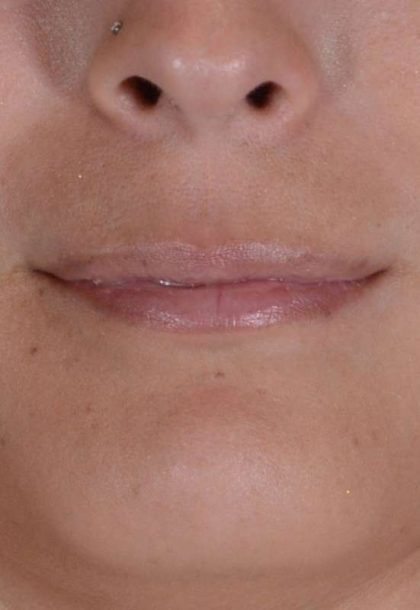 Facial Fat Transfer & Grafting Before & After Patient #1238