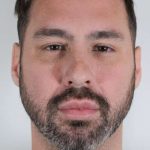 Men's Facelift Before & After Patient #1241