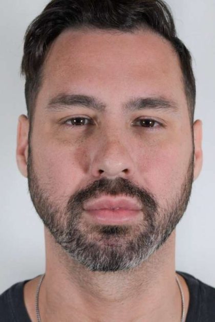 Men's Facelift Before & After Patient #1241