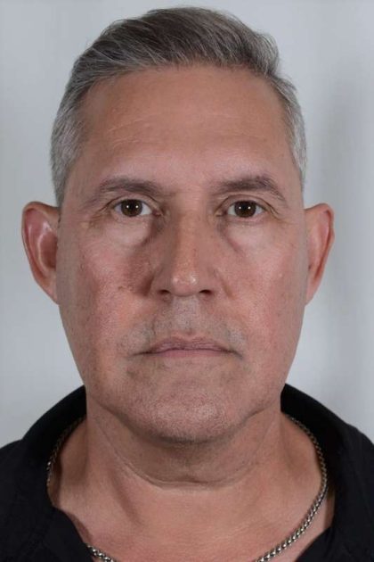 Men's Facelift Before & After Patient #1244