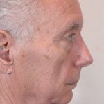 Men's Facelift Before & After Patient #1249