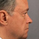 Men's Facelift Before & After Patient #1254