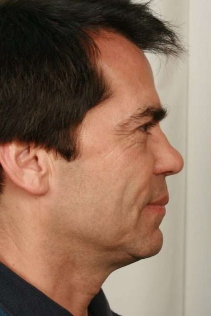 Men's Facelift Before & After Patient #1259