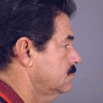 Men's Facelift Before & After Patient #1264
