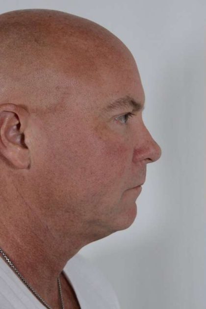 Men's Facelift Before & After Patient #1274
