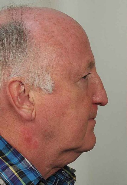 Men's Facelift Before & After Patient #1279