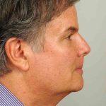 Men's Facelift Before & After Patient #1282