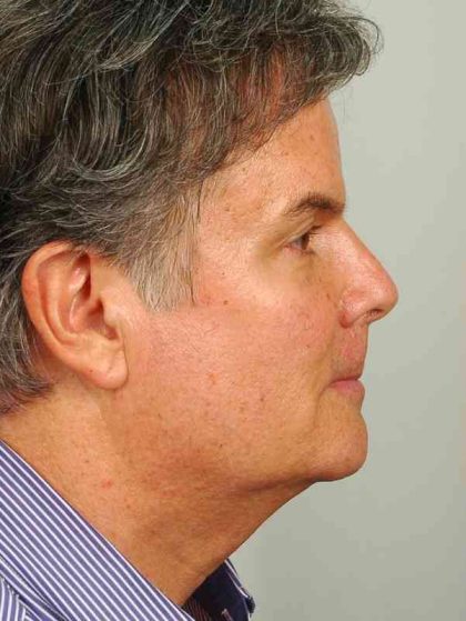 Men's Facelift Before & After Patient #1282