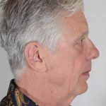 Men's Facelift Before & After Patient #1285