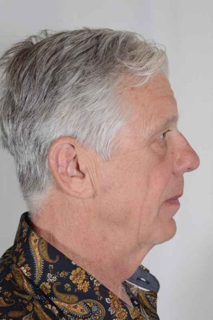 Men's Facelift Before & After Patient #1285