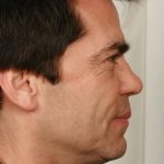 Men's Necklift Before & After Patient #1306