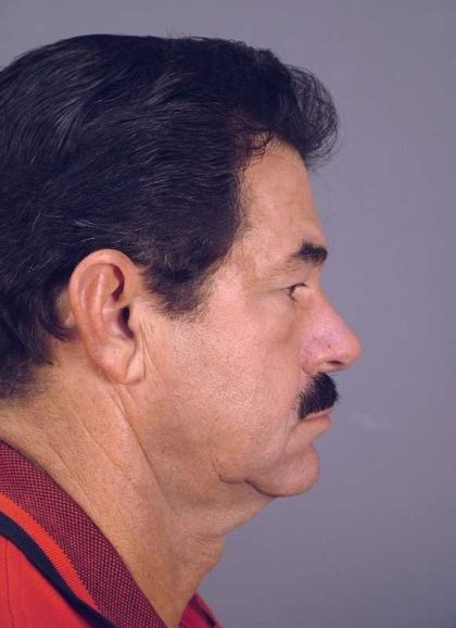 Men's Necklift Before & After Patient #1311