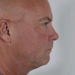 Men's Necklift Before & After Patient #1321