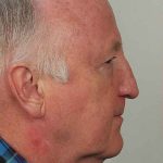 Men's Necklift Before & After Patient #1326