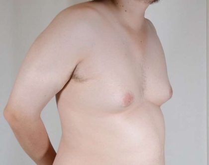 Gynecomastia Before & After Patient #1344