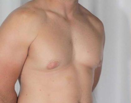 Gynecomastia Before & After Patient #1349