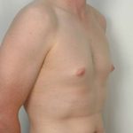 Gynecomastia Before & After Patient #1354