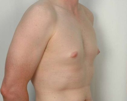 Gynecomastia Before & After Patient #1354