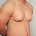 Gynecomastia Before & After Patient #1359