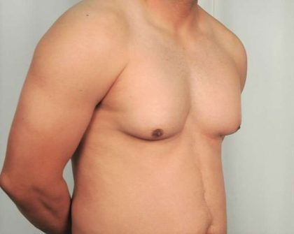 Gynecomastia Before & After Patient #1359