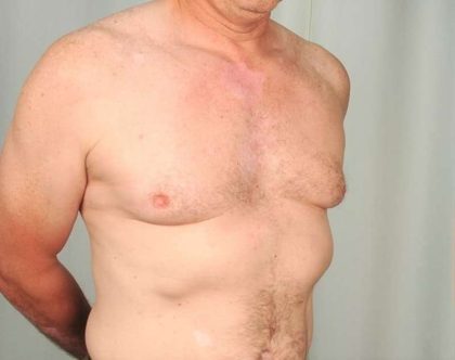 Gynecomastia Before & After Patient #1364