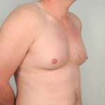 Gynecomastia Before & After Patient #1369
