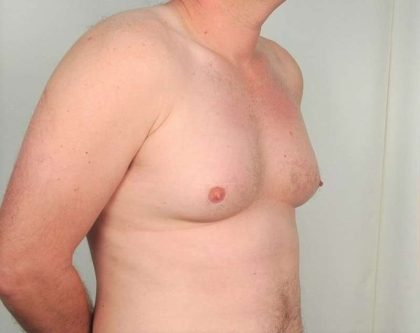 Gynecomastia Before & After Patient #1369