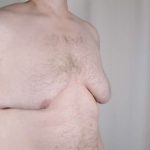 Gynecomastia Before & After Patient #1374