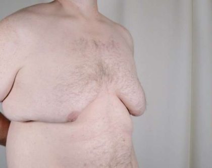 Gynecomastia Before & After Patient #1374
